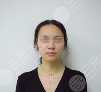 生物除皱网友体验除皱前