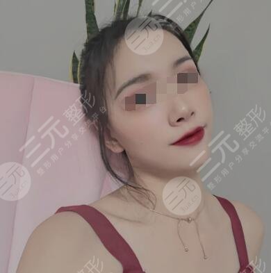 生物除皱网友体验除皱后一个月