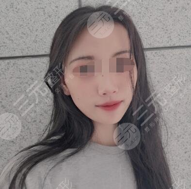 生物除皱网友体验除皱后果