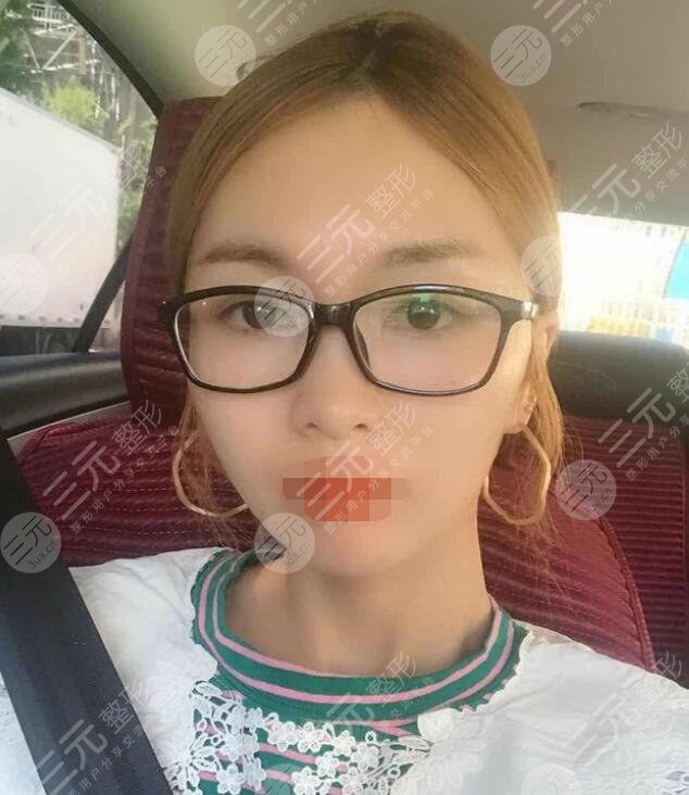 btl射频紧肤体验果后果