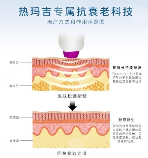 热玛吉相关问答科普