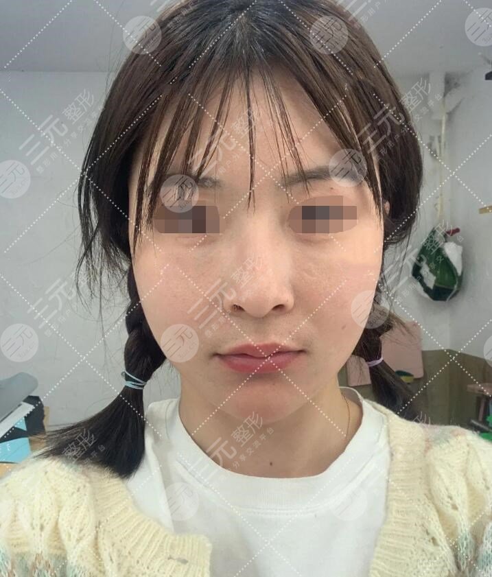 体验btl射频真实果后