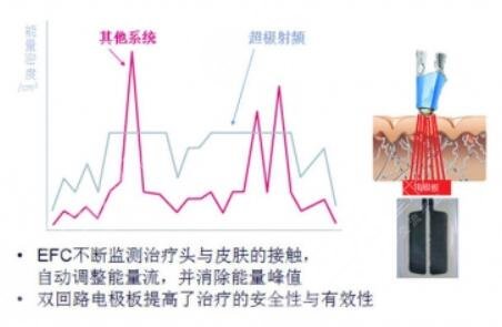 btl射频紧肤提拉是什么操作方式