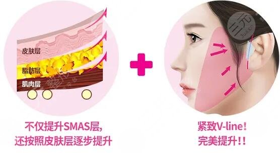 激光除皱术是什么原理