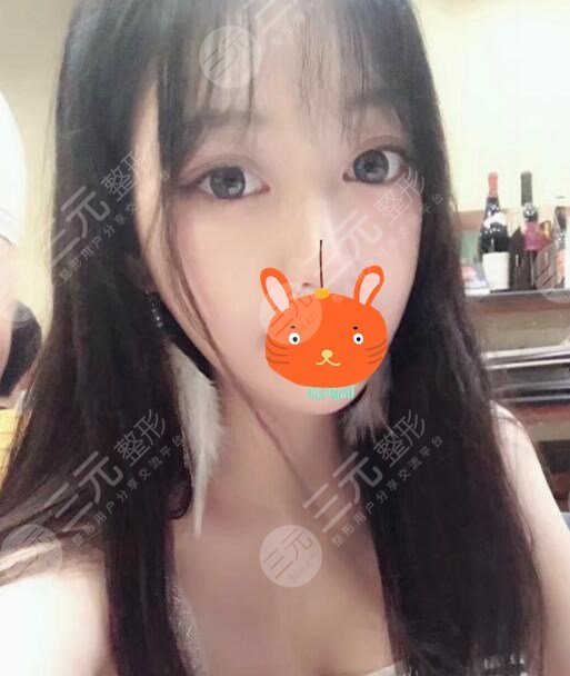 激光除皱后一个月