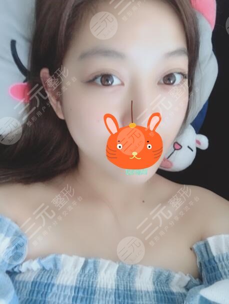 激光除皱后果