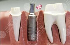 韩国奥齿泰种植牙的使用寿命是多久？来看做种植牙之后的注意事项吧！