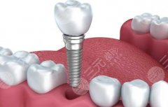 种植牙有什么风险和后遗症？种植牙是什么原理？