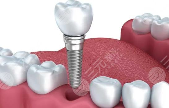 种植牙