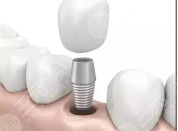 种植牙