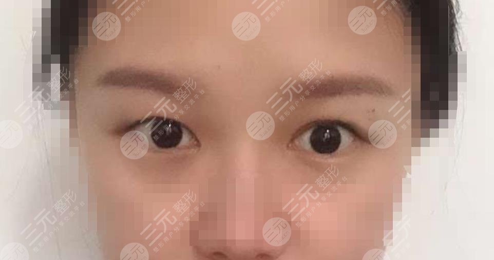 做双眼皮修复之前