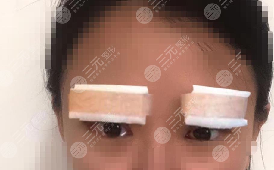 做双眼皮修复之后