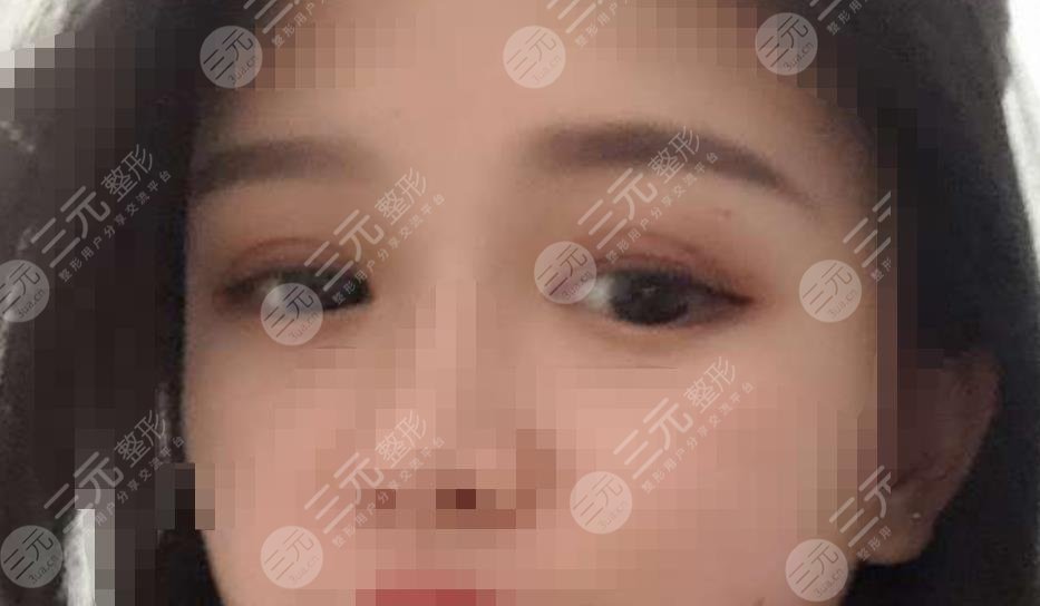 做双眼皮修复之后