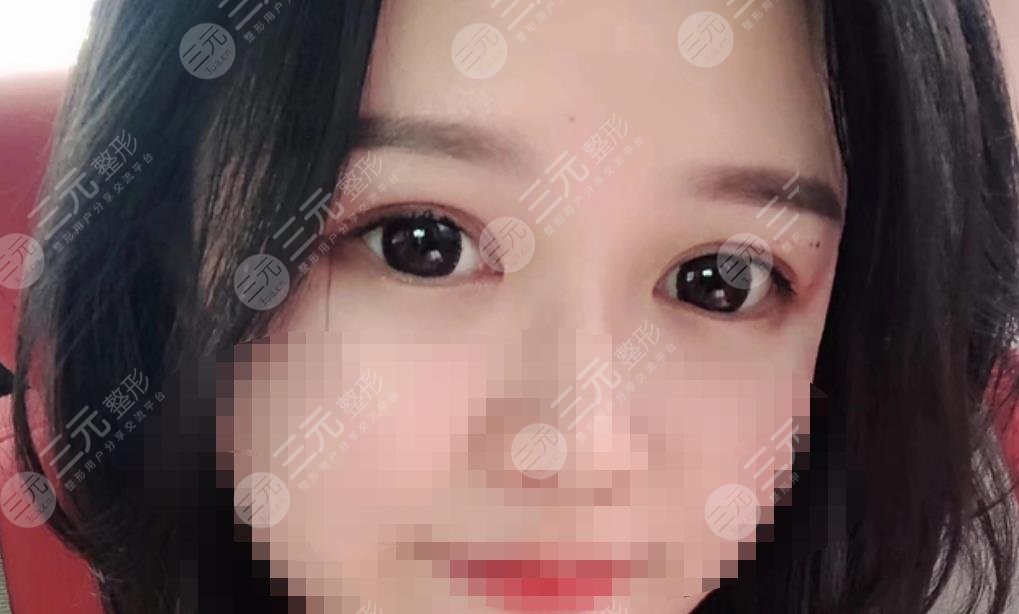 做双眼皮修复之后