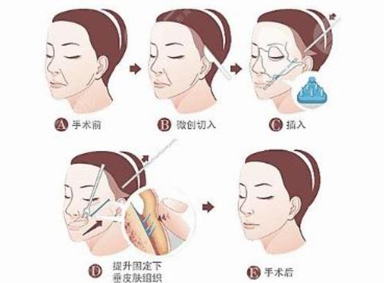 拉皮除皱