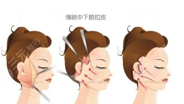 面部拉皮过程