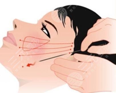 面部拉皮手术注意事项