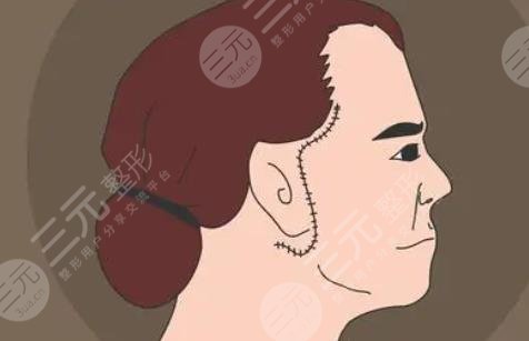 面部拉皮切口