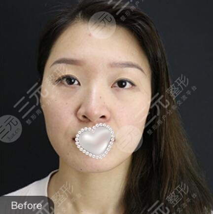 欧洲之星激光除皱提升果图