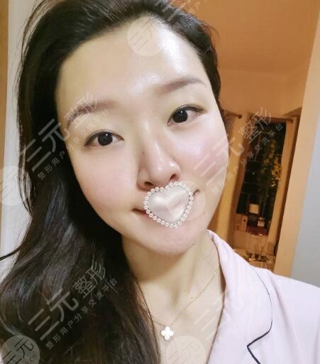 欧洲之星激光除皱提升果图