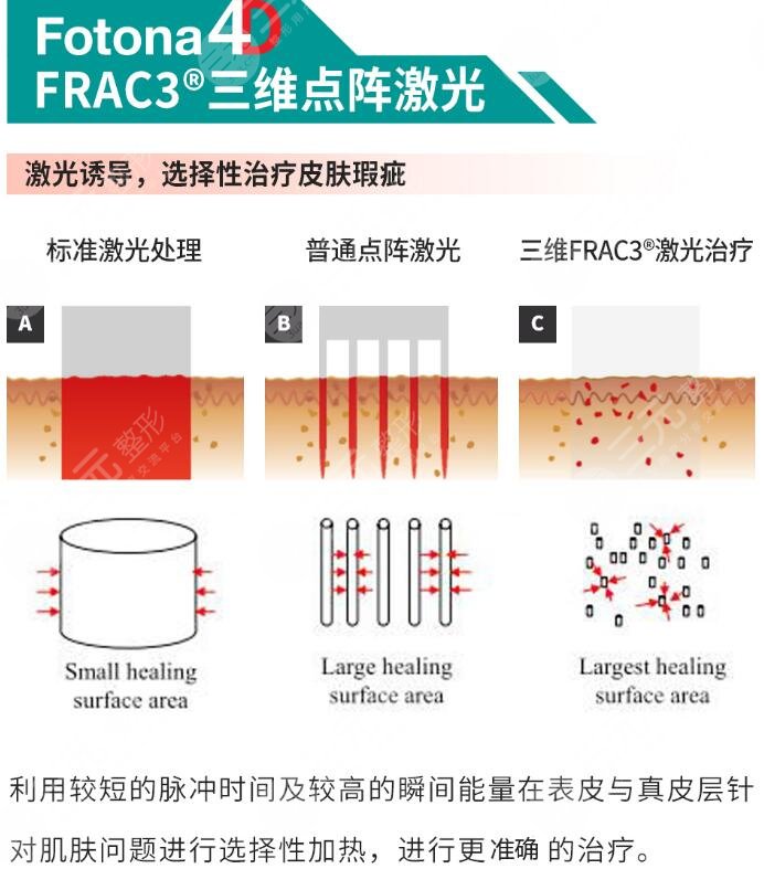 欧洲之星点阵激光降低风险吗