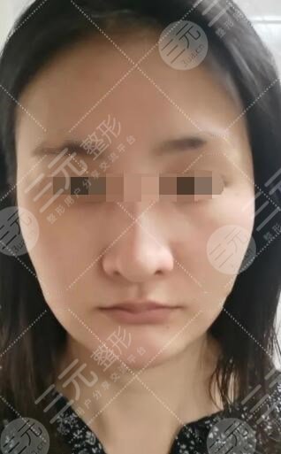 小拉皮手术前