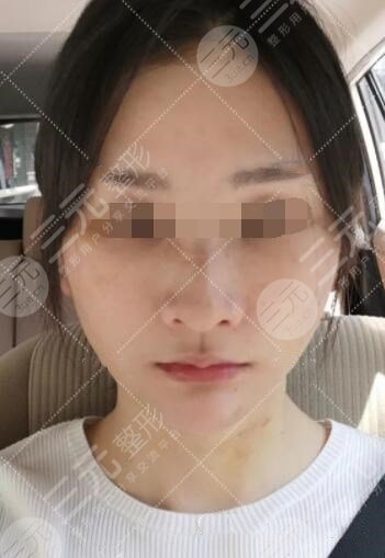 小拉皮手术后