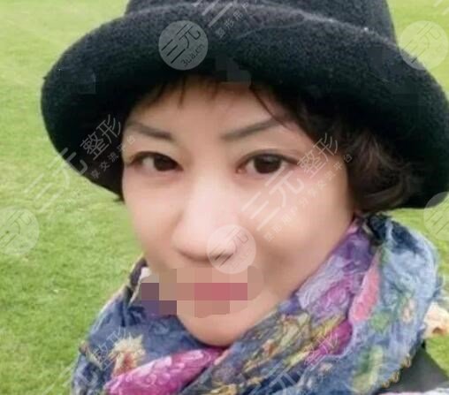 小拉皮手术案例后2周