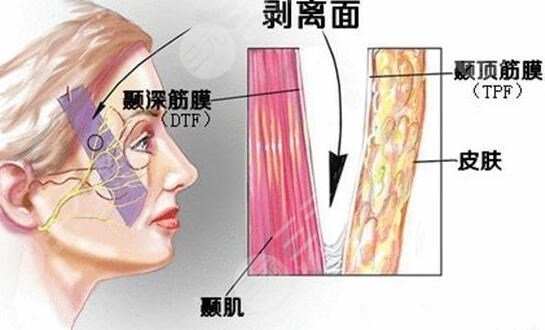 小拉皮手术
