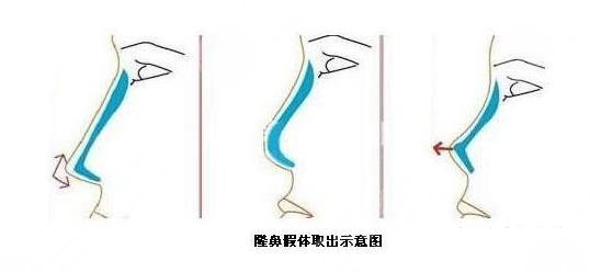 把鼻子假体取出照片对比照片