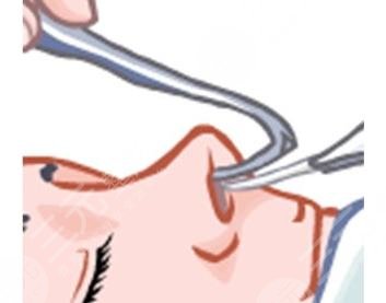 隆鼻假体取出手术恢复时间