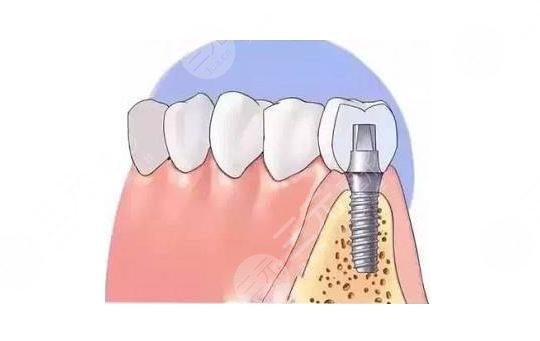 韩国奥齿泰种植牙相关介绍科普