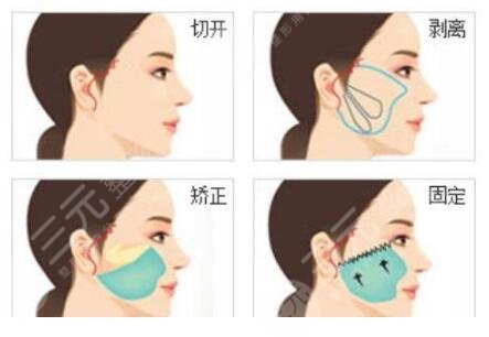 面部拉皮手术有风险吗