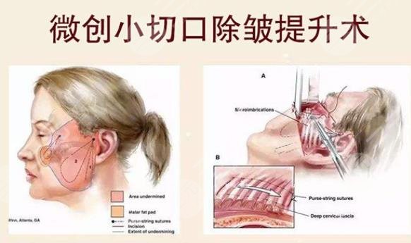 小切口除皱保持几年