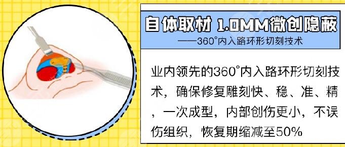傅晓茜 隆鼻技术优点