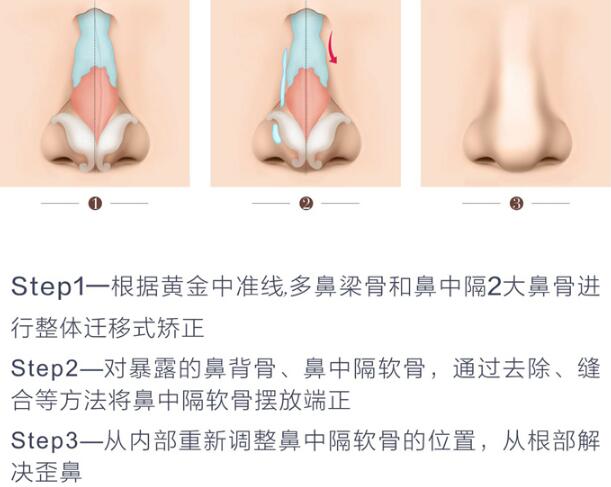 什么是鼻综合手术