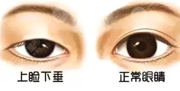 上睑下垂