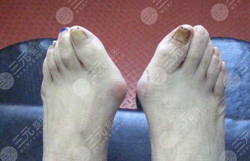 大脚骨手术微创的好还是传统的好科普讲解如何选择不再盲目