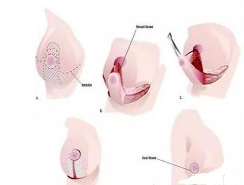 乳房提升棒棒糖切口跟双环切口区别