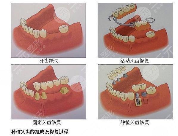 镶牙多少钱一颗牙收费标准是怎么样的附价格表注意事项