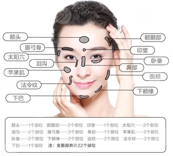 脂肪填充相关知识科普——脂肪填充太阳穴