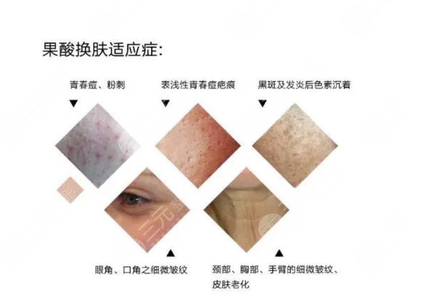 果酸焕肤和水杨酸哪个好?