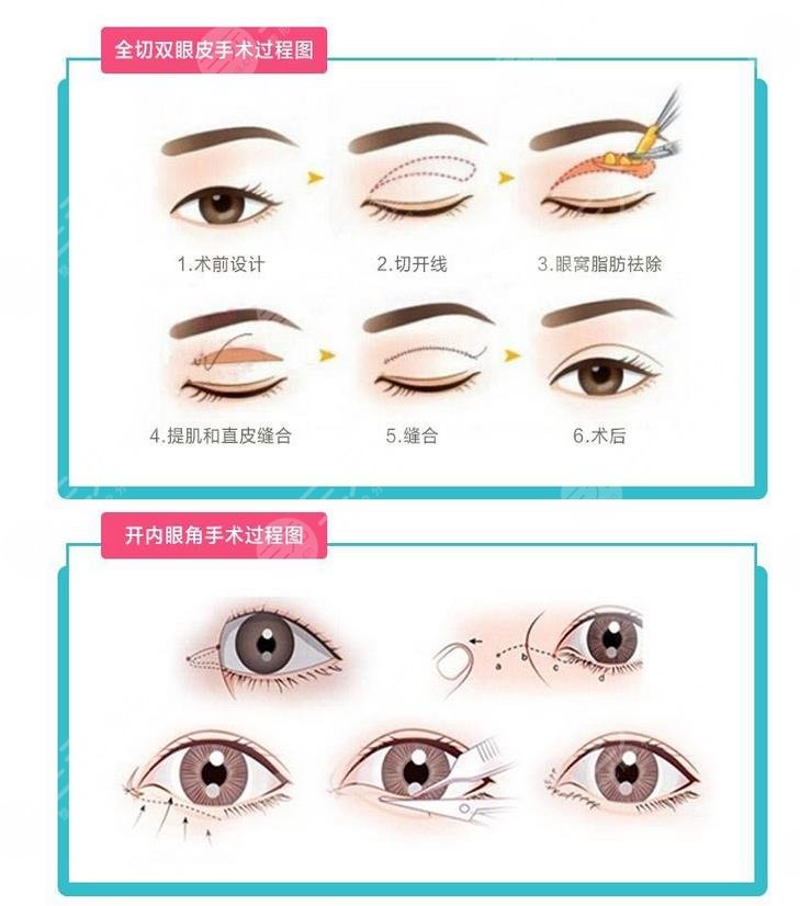 双眼皮整形+开眼角整形原理
