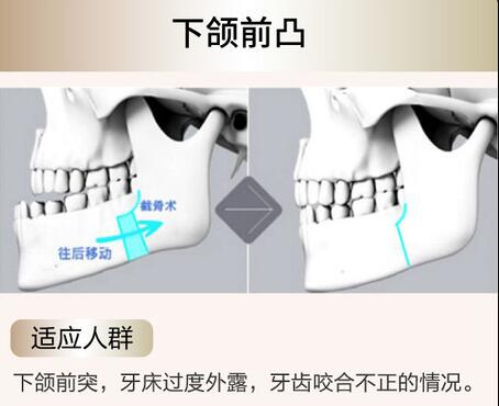 王剑宁正颌案例反馈