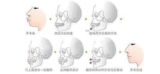 王剑宁正颌案例反馈