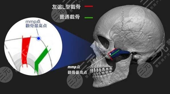 做磨骨手术