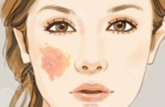 胎记激光能基本去除吗？科普带你了解！附术后注意事项&2021参考价！