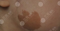 胎记怎么去除降低风险？方法科普&参考价来咯，搞定尴尬印记，自信UP！