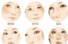 激光美容祛斑多少钱，靠谱吗？2021价格表参考，净斑攻略出炉！