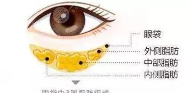 去眼袋